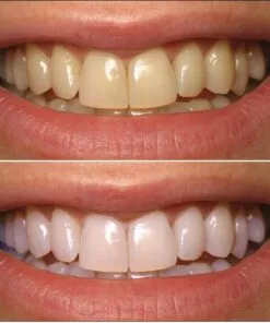 before and after Carbamide Peroxide Refill