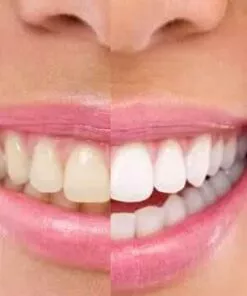 teeth bleaching uk